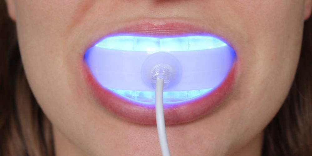 Business potential and demand for teeth whitening kits
